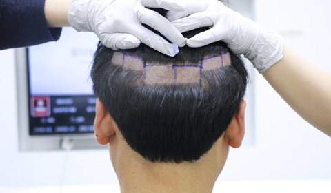Partial shaving in the occipital region image