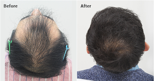 If there is insufficient hair in the donor area image