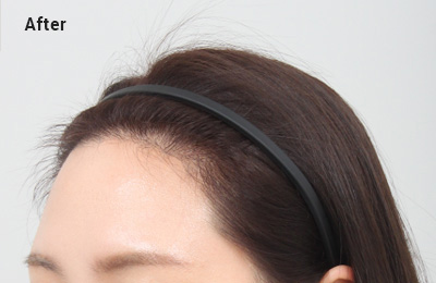 soft hair in the hairline image