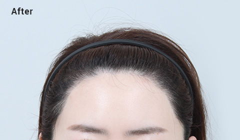 Asymmetric forehead after image