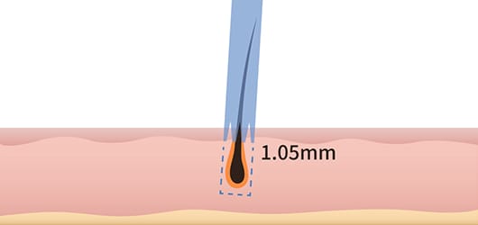 최적의 모낭채취로 상처 최소화 일러스트 이미지