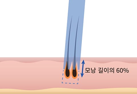 모낭 길이의 60~70% 일러스트 이미지