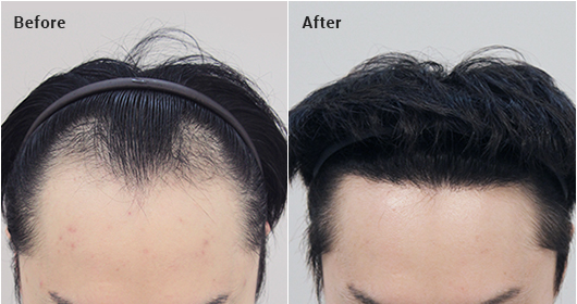 Non-incisional partial shaving, 1500 hair follicles, 12 months later image