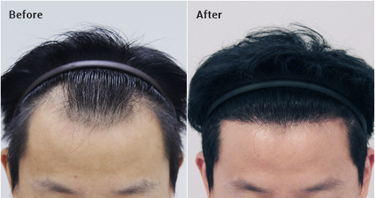 Non-incisional without shaving, 1200 hair follicles, 9 months later image