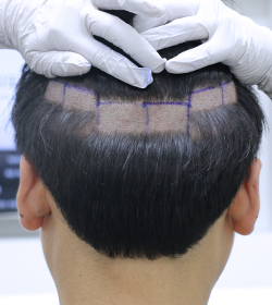 Partial shaving of occipital region image