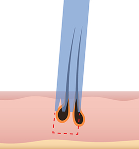 Damaged hair follicles image