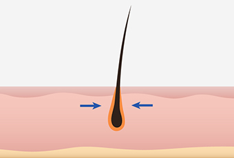 Snug fit implantation image