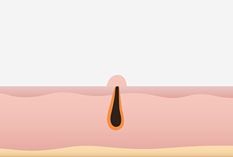 Immediately after snug fit implantation image