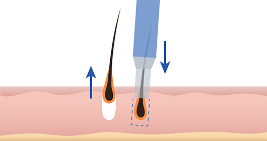 Hair planting device popping phenomenon image