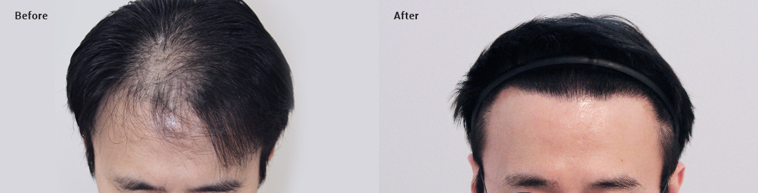 Non-incisional without shaving, 1500 hair follicles, 10 months later image