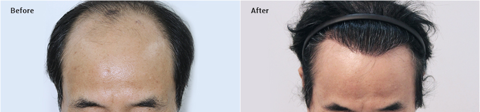 Non-incisional partial shaving 2000 hair follicles, 10 months later image