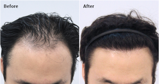 Non-incisional partial shaving. 2000 hair follicles. 10 months later image