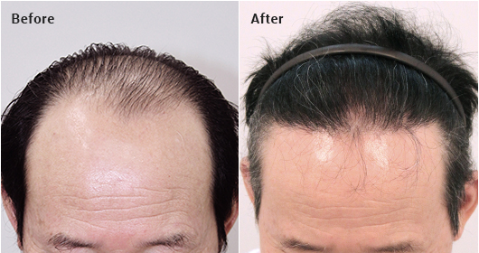 Non-incisional partial shaving. 2000 hair follicles. 10 months later image