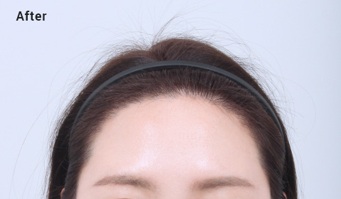 Angular shaped forehead after image