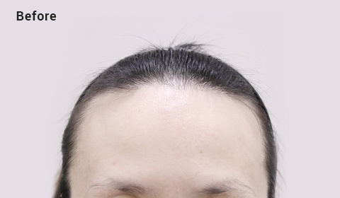 High forehead before image