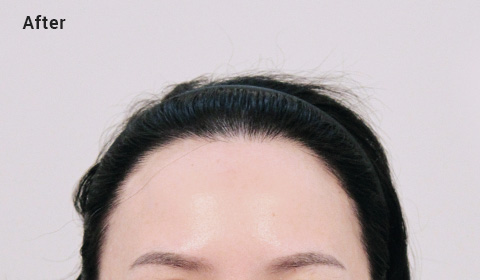 High forehead after image