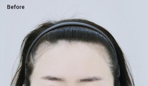 Asymmetric forehead before image